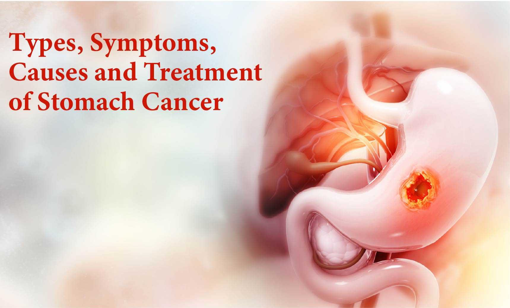 Types, Symptoms, Causes and Treatment of Stomach Cancer| Dr. Priya Tiwari