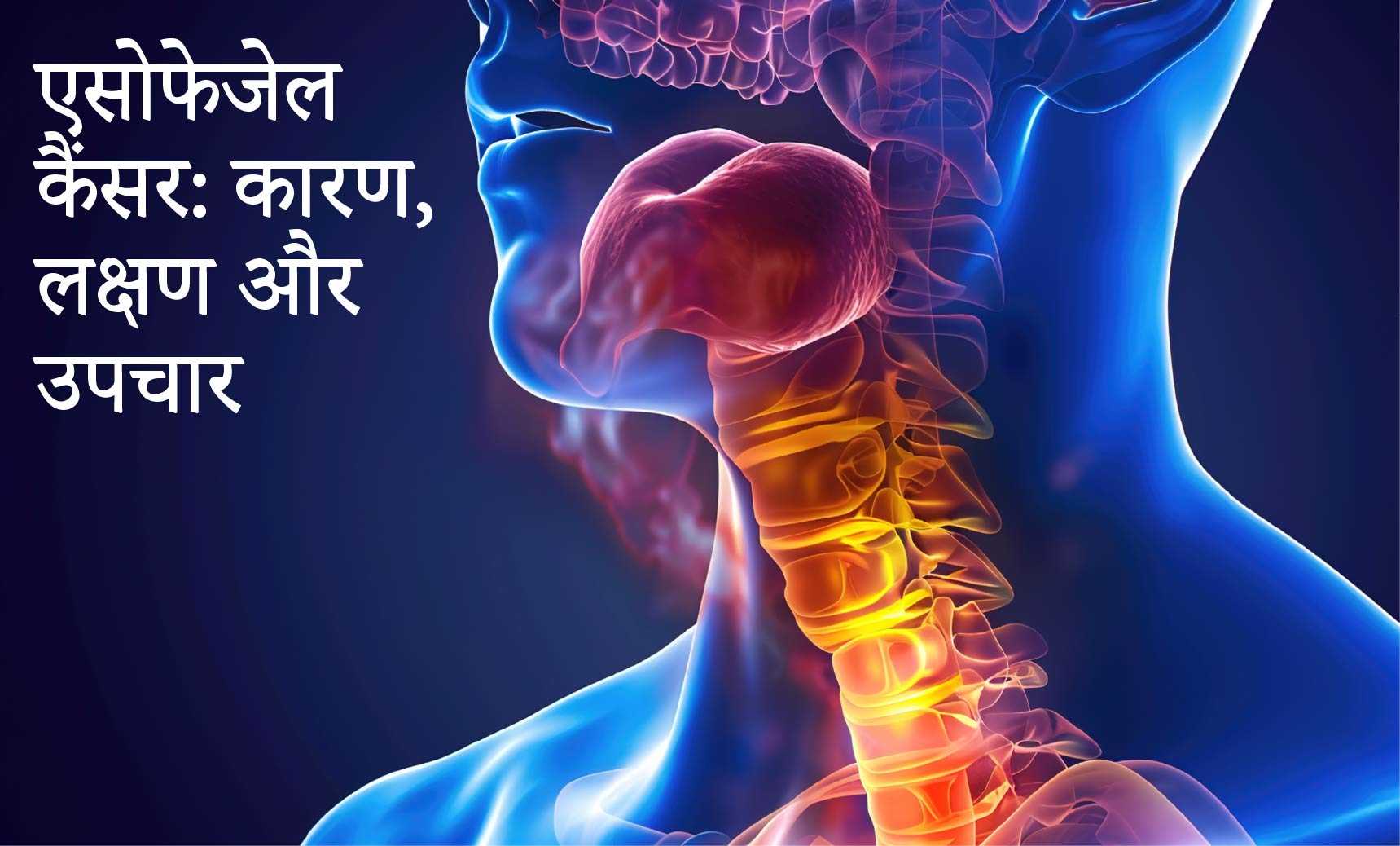 एसोफेजेल कैंसर: कारण, लक्षण और उपचार