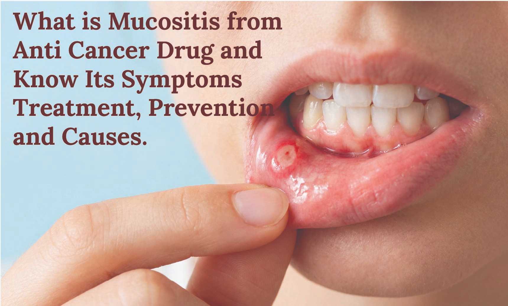 What is Mucositis from Anti Cancer Drug and Know Its Symptoms Treatment, Prevention and Causes.