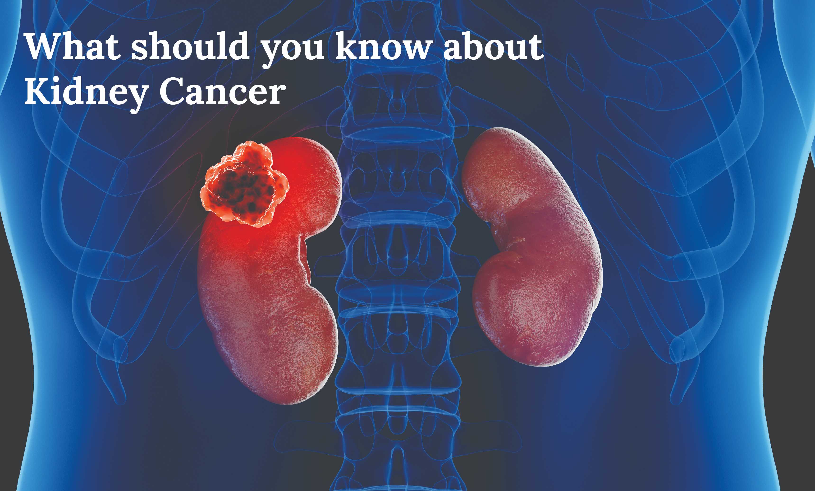What should you know about Kidney Cancer