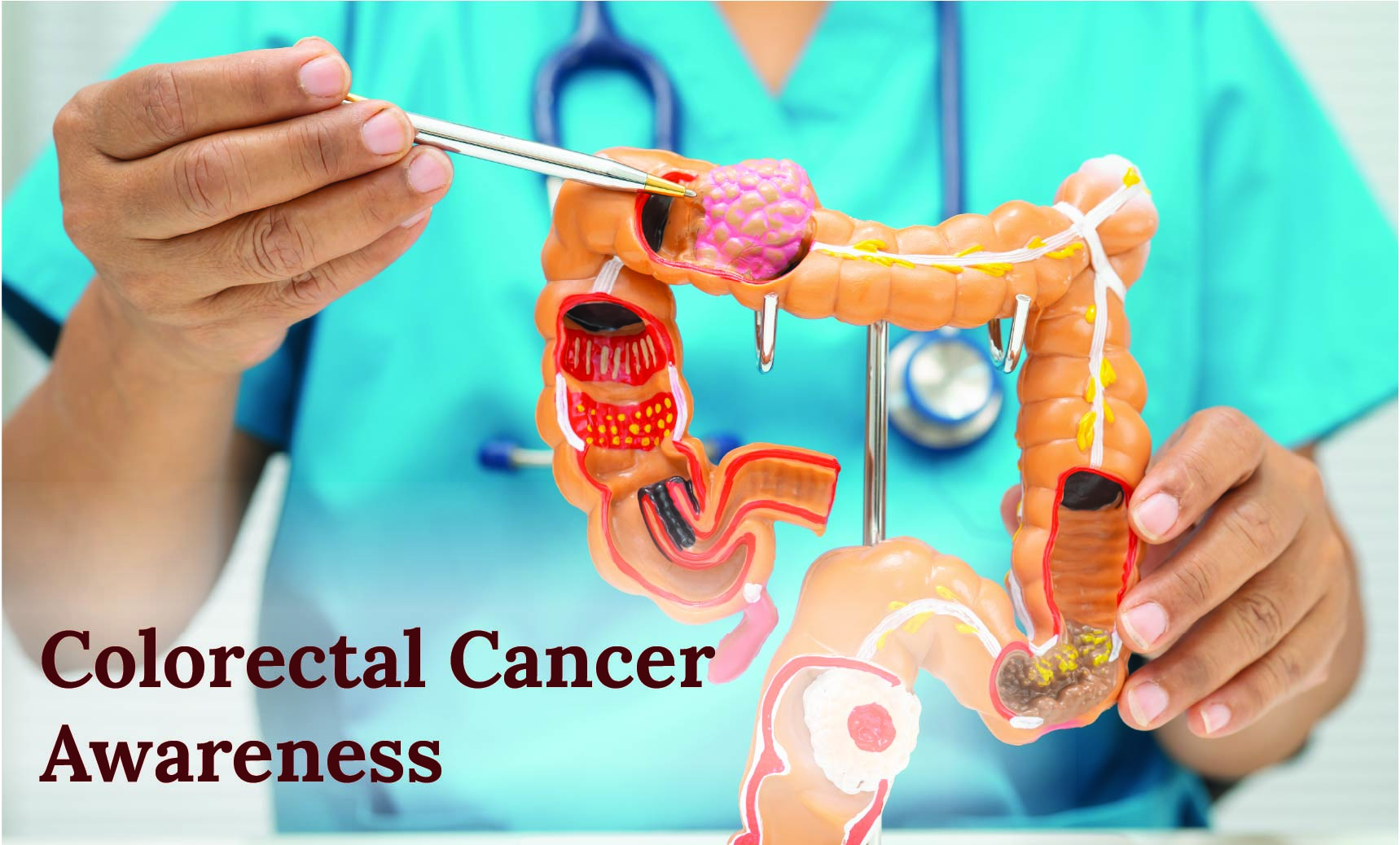 Colorectal Cancer Awareness | Dr. Priya Tiwari | Big FM