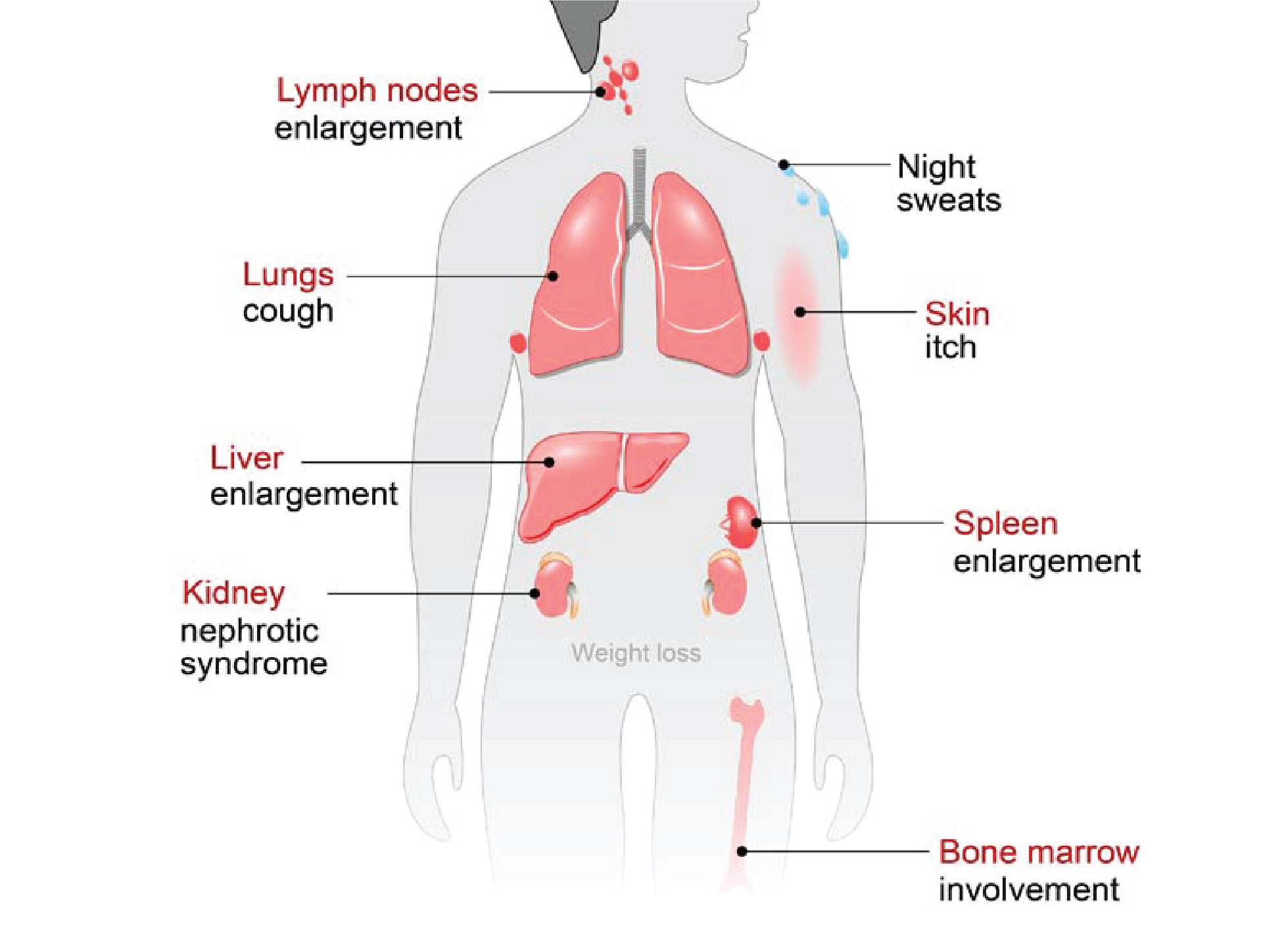 Symptoms-of-Lymphoma