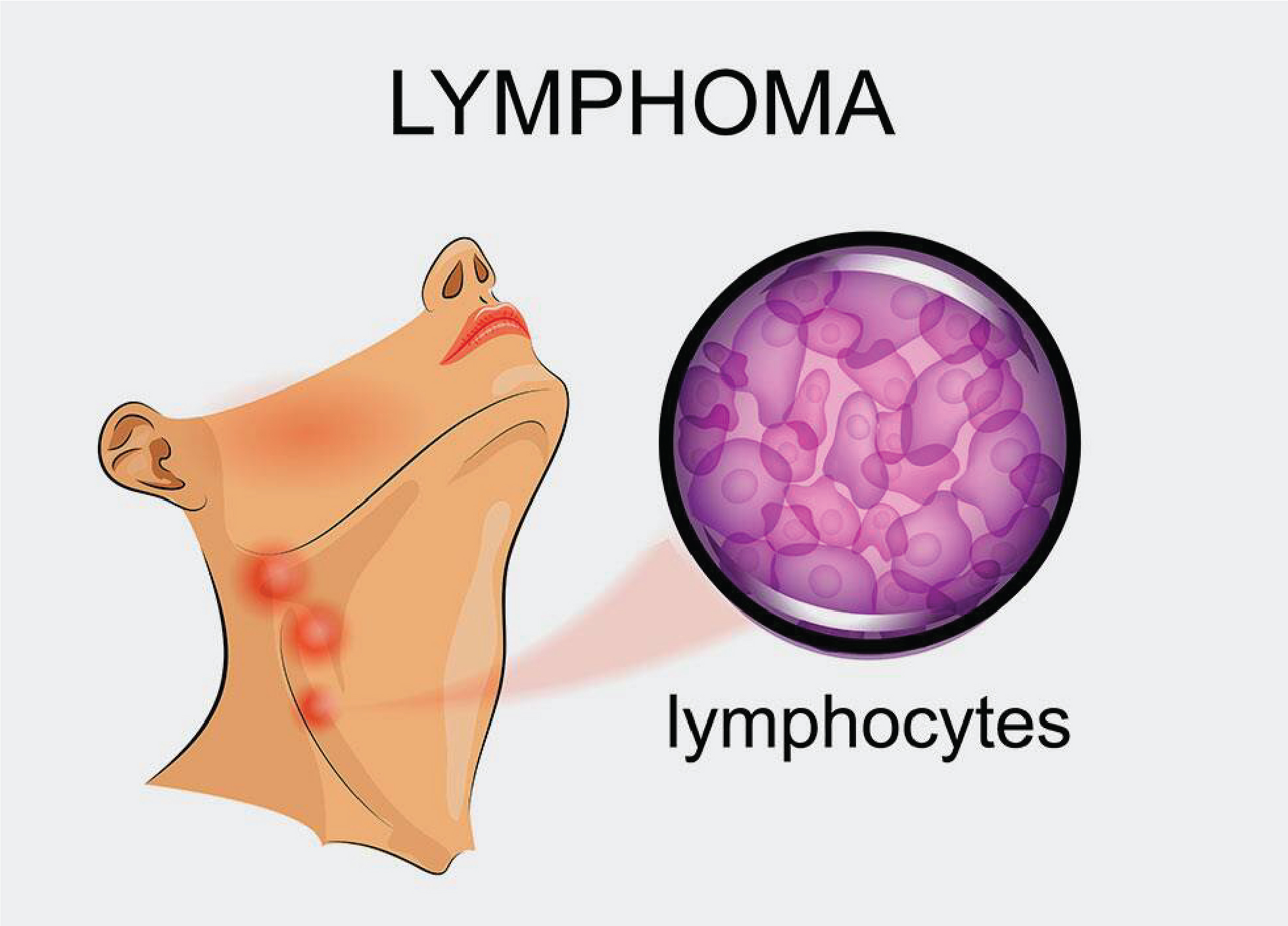 Lymphoma-Cancer-Specialist-In-Delhi