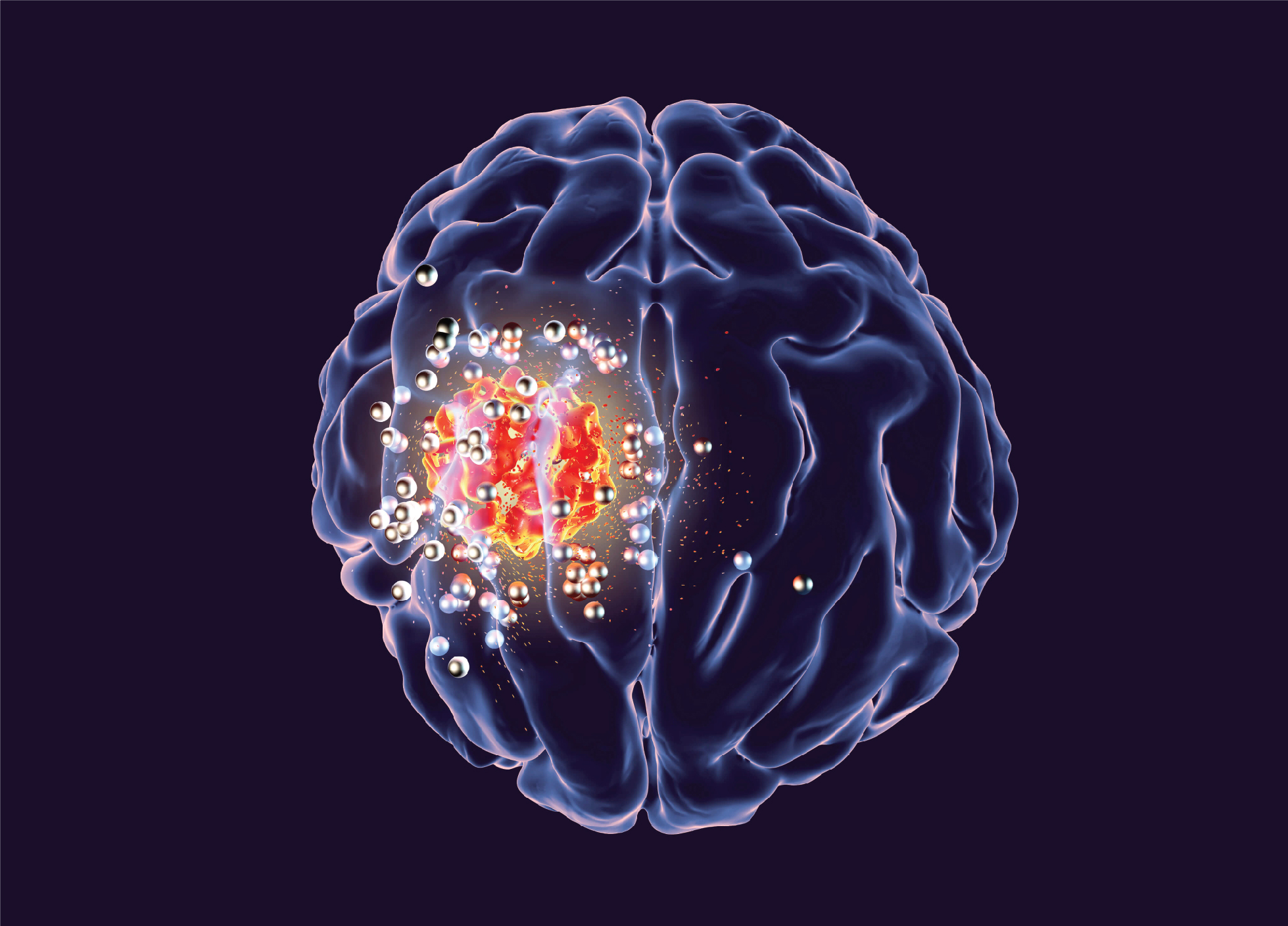 Brain-Tumor-Doctor-In-Delhi