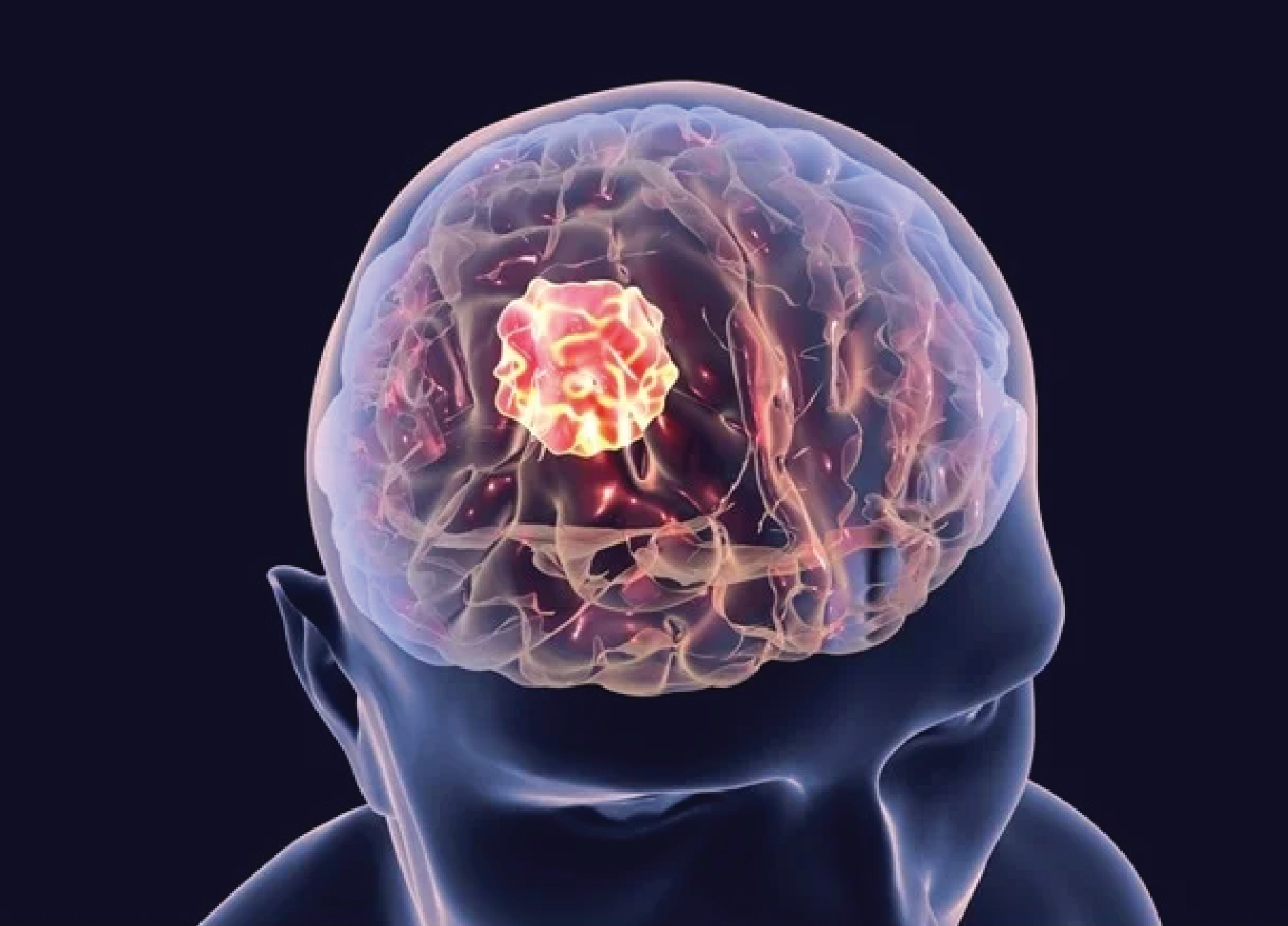 Brain Tumor Specialist in Delhi