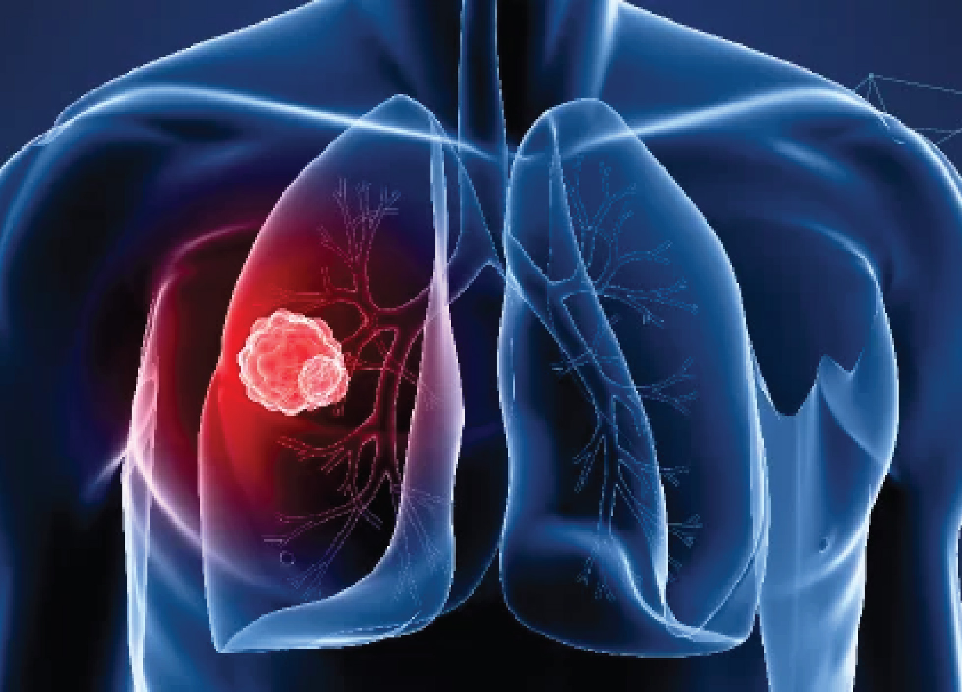 Lung Cancer Specialist in Delhi