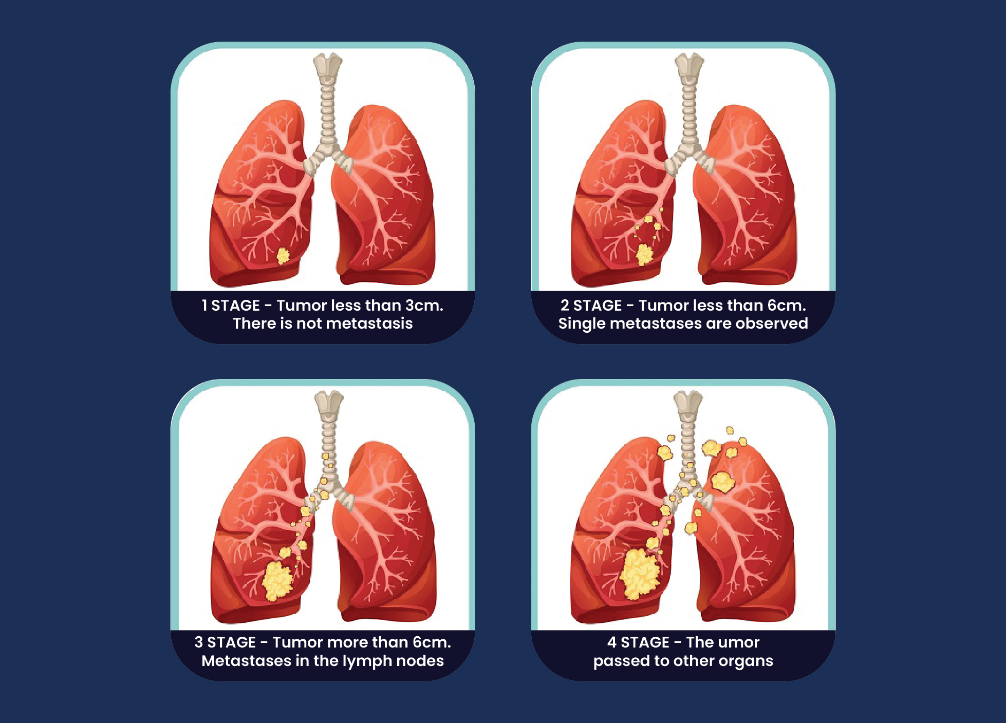 Lung Cancer Specialist in Delhi
