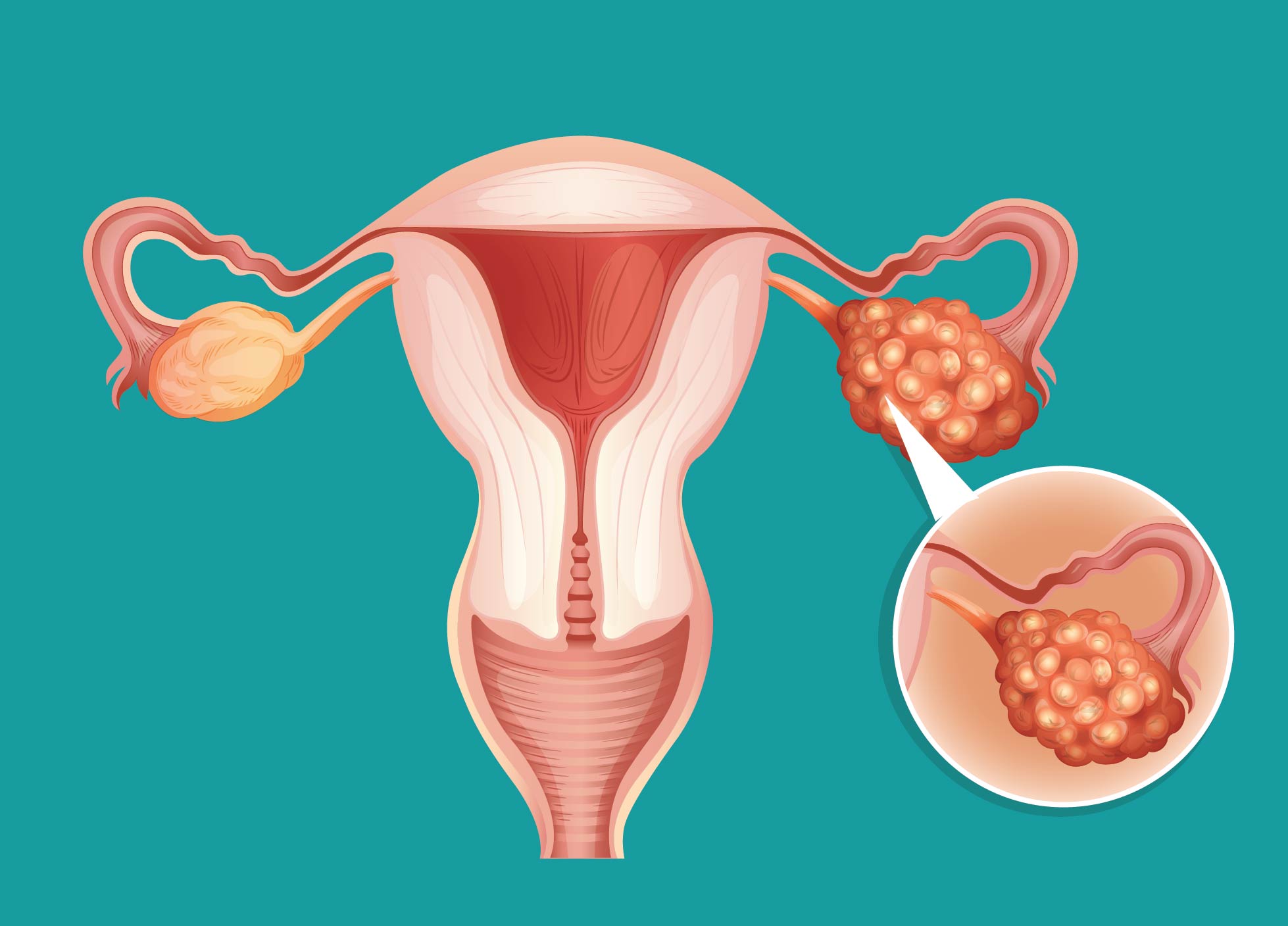 Ovarian Cancer Specialist in Delhi