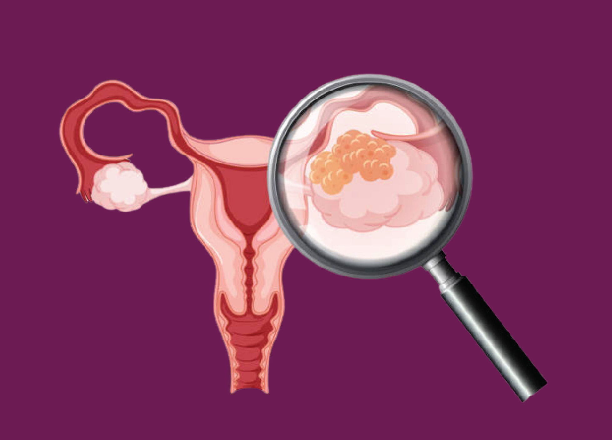 Ovarian Cancer Specialist in Delhi